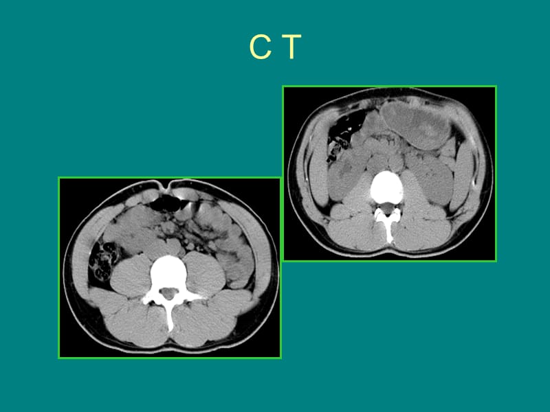 腹部影像诊断-肾脏CT_第3页