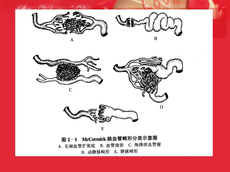 大脑动静脉畸形影像表现.ppt_第3页