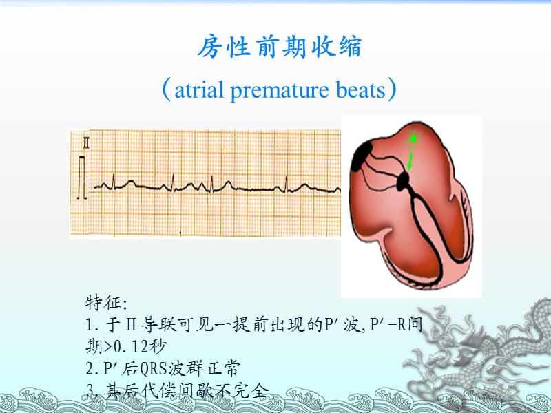 常见心律失常的ECG表现及药物治疗_第3页