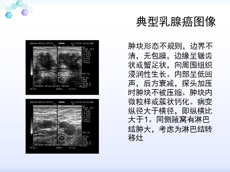 乳腺癌的声像图特点_第3页