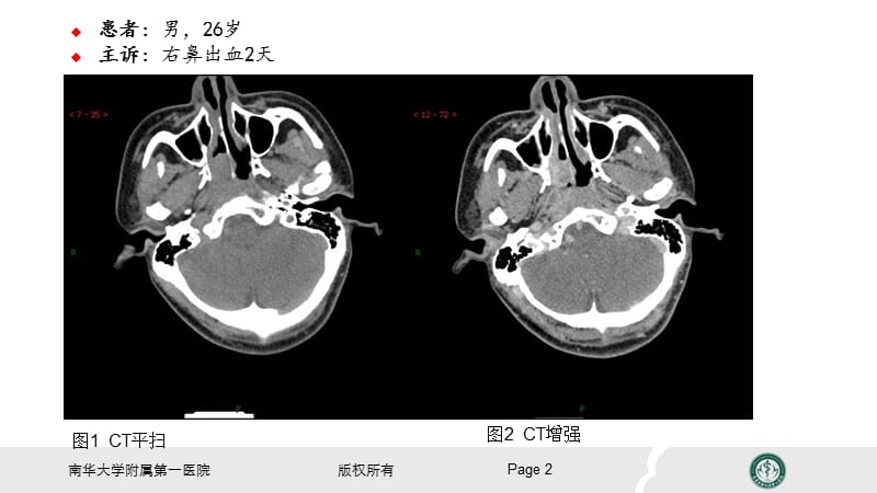 鼻咽纤维血管瘤的影像表现及临床.ppt_第2页