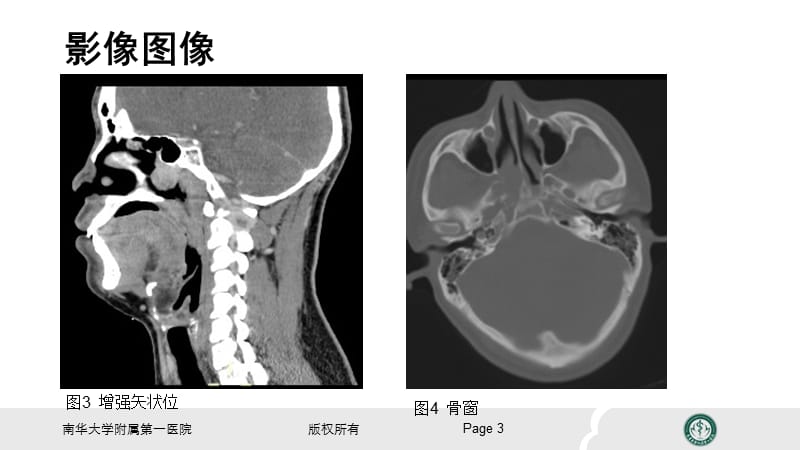 鼻咽纤维血管瘤的影像表现及临床.ppt_第3页