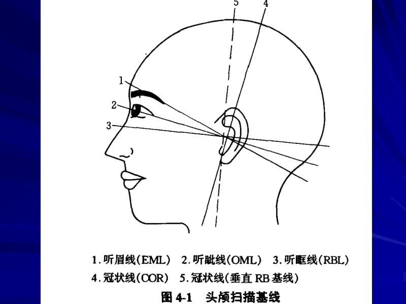 《头颅CT断层解剖》PPT课件.ppt_第3页