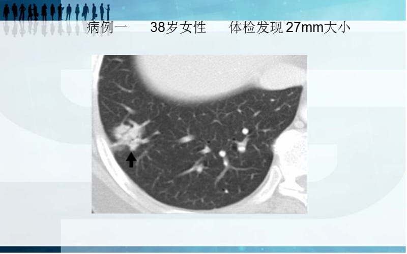 肺磨玻璃阴影影像诊断及临床处理原则.ppt_第2页