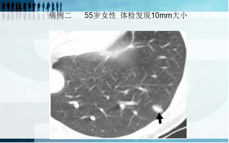 肺磨玻璃阴影影像诊断及临床处理原则.ppt_第3页