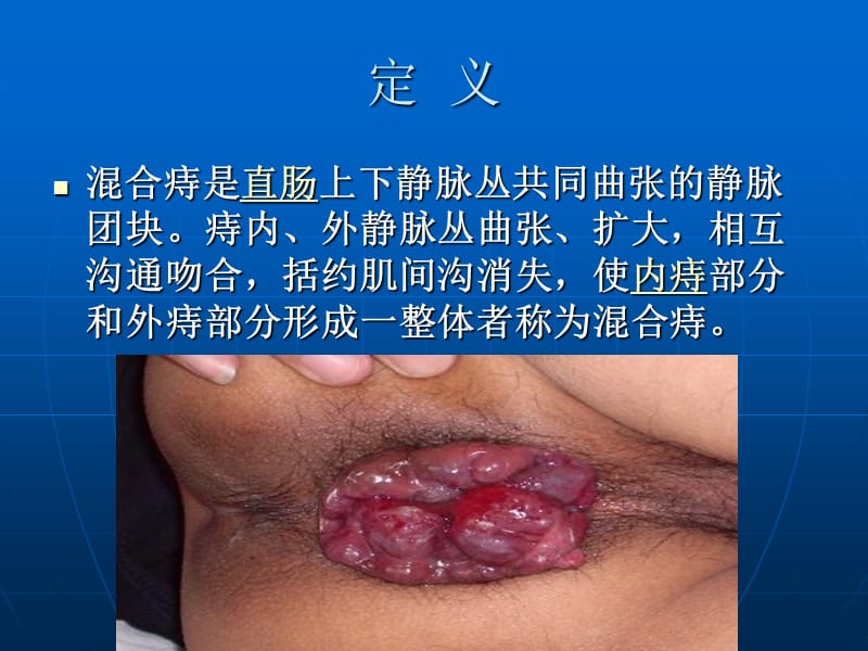 混合痔的诊断与治疗.ppt_第2页