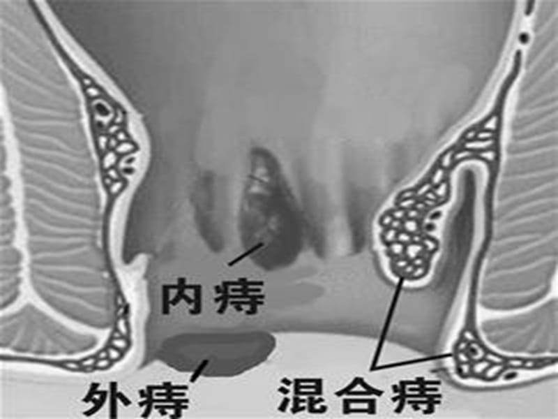 混合痔的诊断与治疗.ppt_第3页