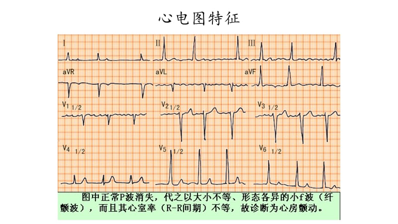 谈房颤及抗凝管理.ppt_第3页