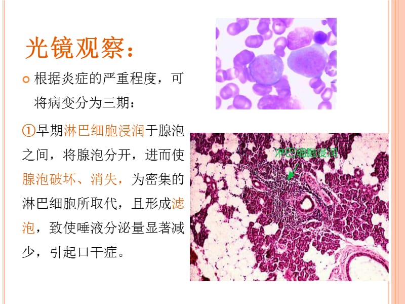 舍格伦综合征病理变化.ppt_第3页