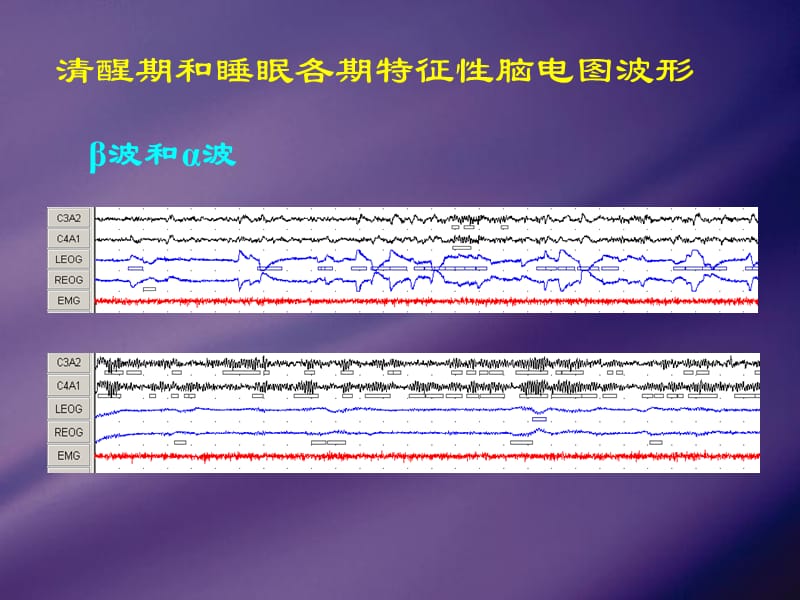 成人脑电图的判读及睡眠分期.ppt_第3页