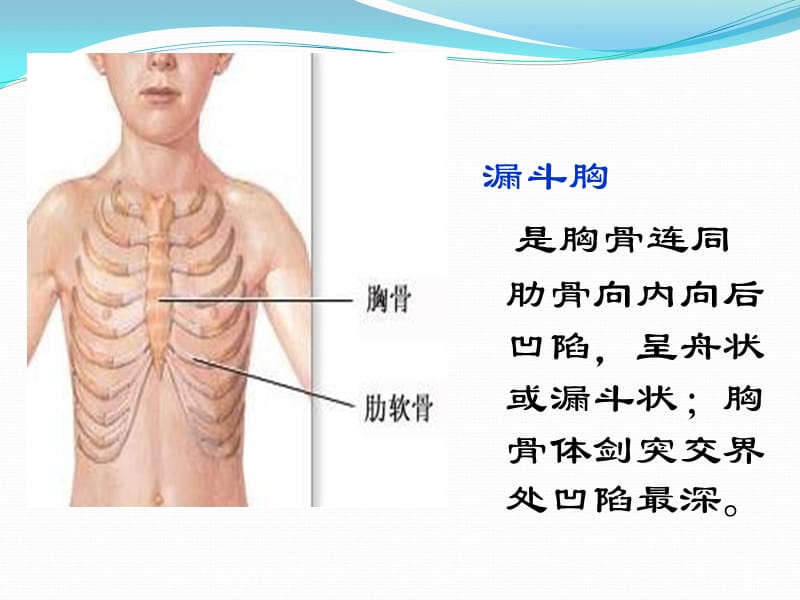 漏斗胸_ppt_第3页