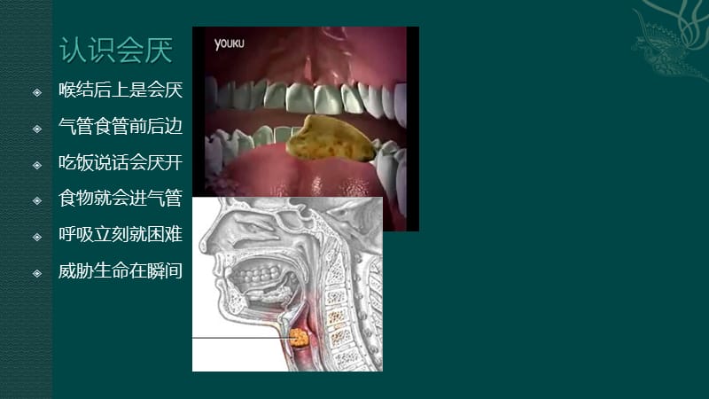 气道异物梗阻的急救处理.ppt_第3页