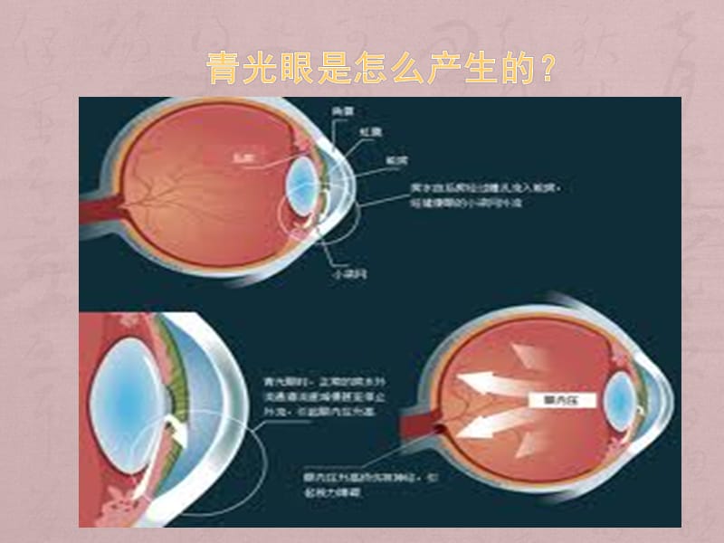 青光眼的药物治疗_第3页