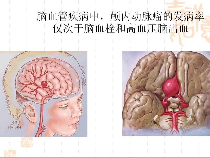 脑动脉瘤手术配合.ppt_第2页