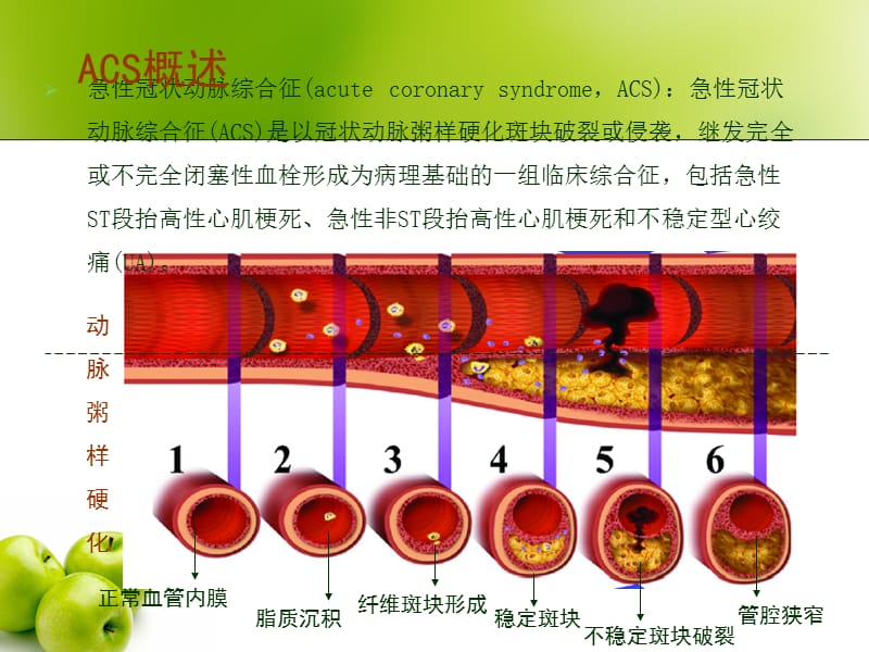 2018年急性冠脉综合征的护理.ppt_第2页