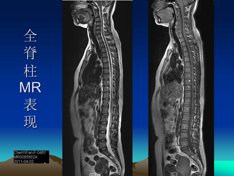 脊柱外伤影像学表现.ppt_第3页