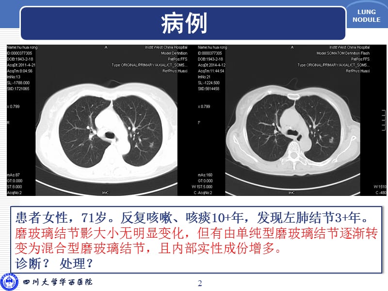 肺磨玻璃结节的诊断与临床处理策略.ppt_第2页