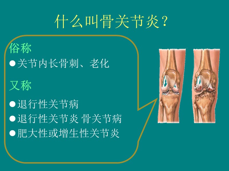 膝关节骨性关节炎的分级治疗_第2页
