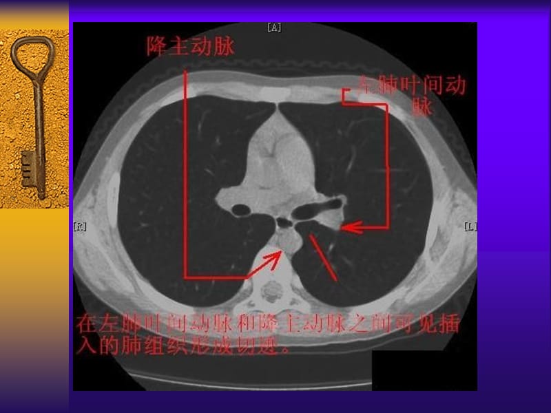 胸部CT断层解剖标注详解.ppt_第3页