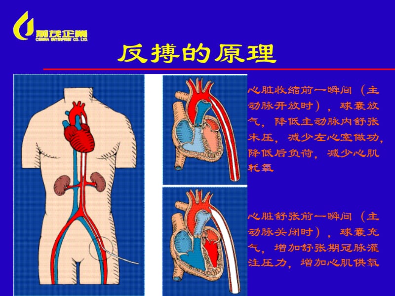 IABP主动脉内球囊反搏经典.ppt_第3页