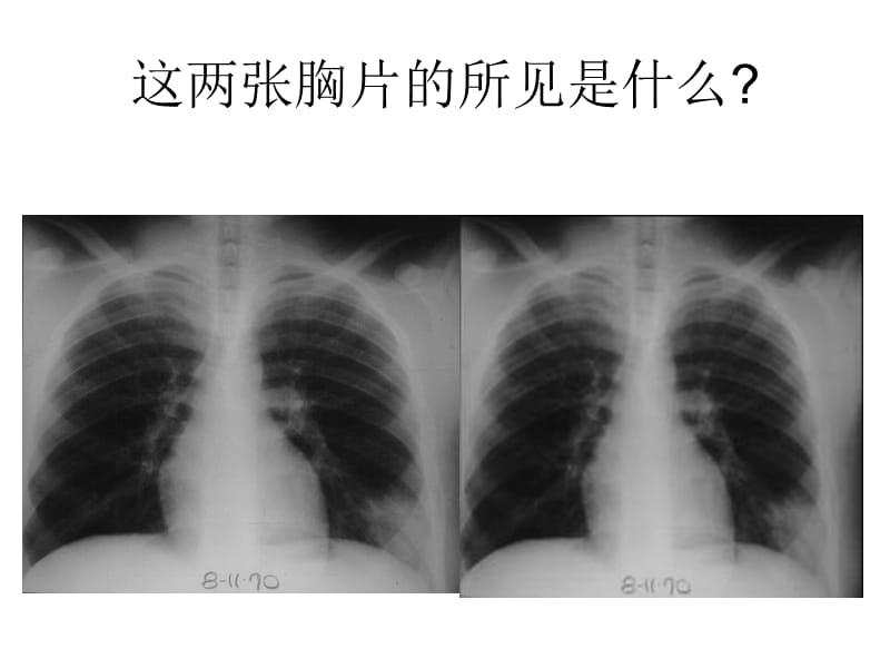 肺部疾病鉴别诊断.ppt_第2页