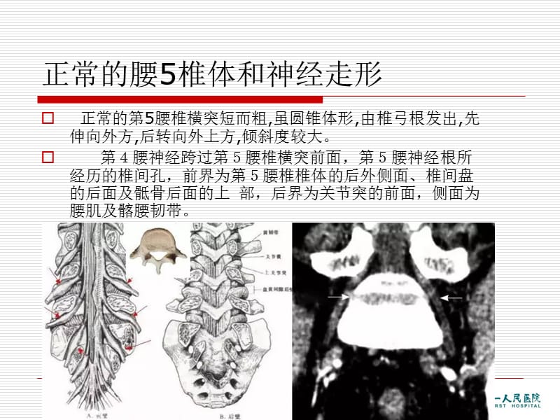腰椎横突肥大综合征.ppt_第3页