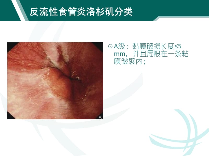 消化道疾患内镜分级诊断_第2页