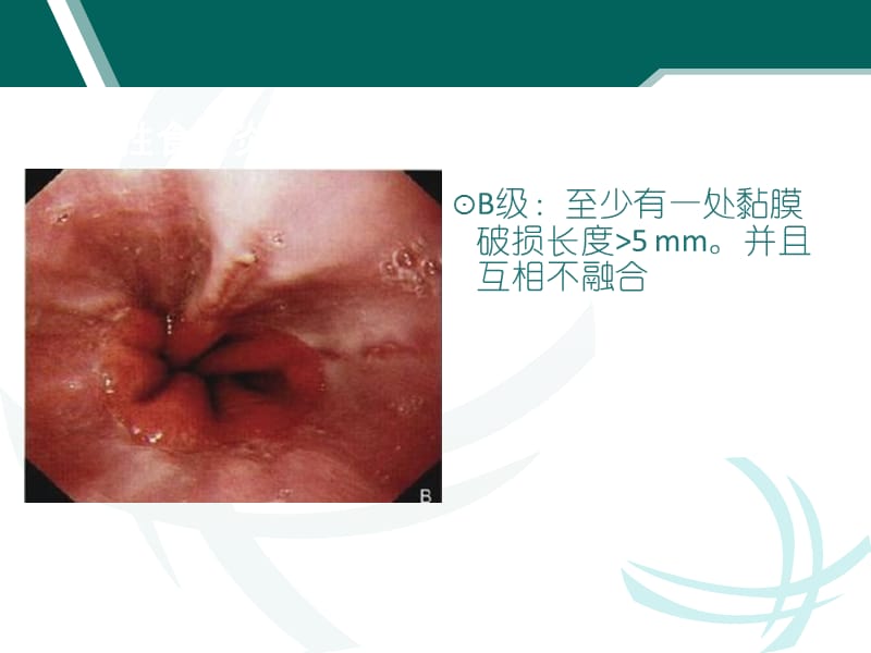 消化道疾患内镜分级诊断_第3页