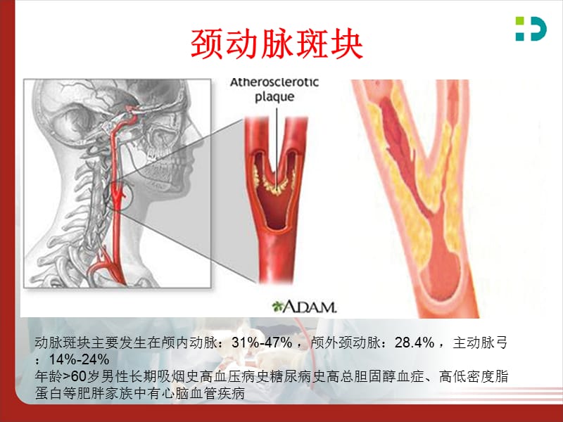 颈动脉斑块的识别与处理.ppt_第3页