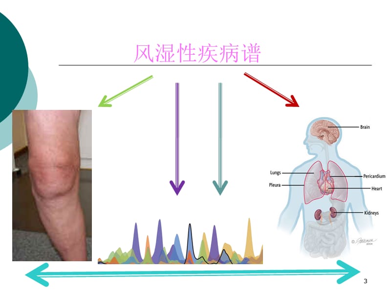 神经精神性红斑狼疮ppt课件_第3页