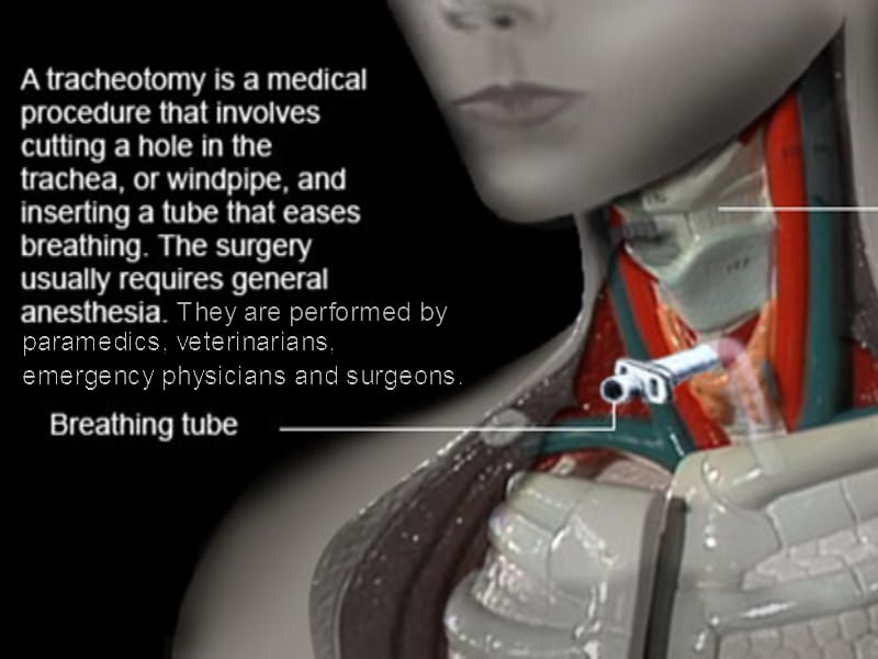 气管切开术(Tracheotomy).ppt_第1页