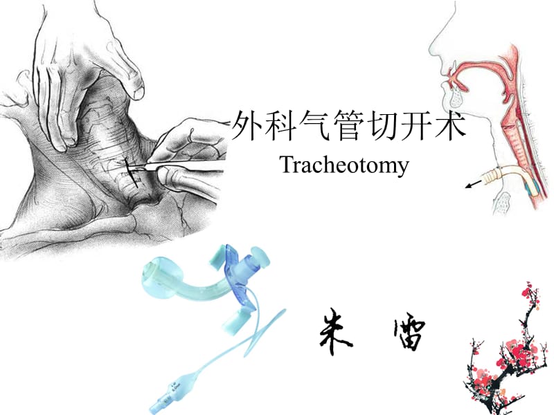 气管切开术(Tracheotomy).ppt_第2页