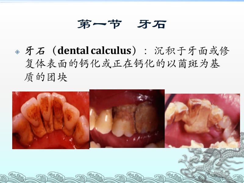 牙周病的局部促进因素ppt课件_第2页