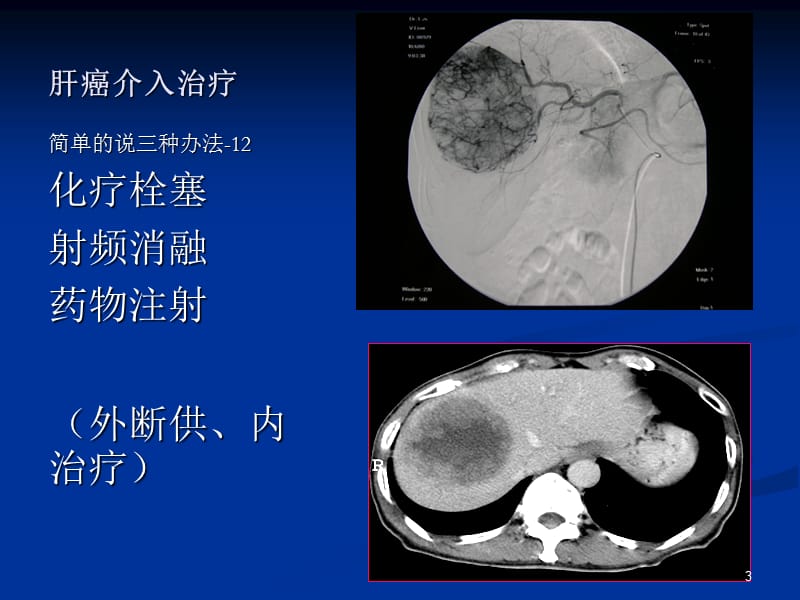 肿瘤介入及综合治疗ppt课件_第3页