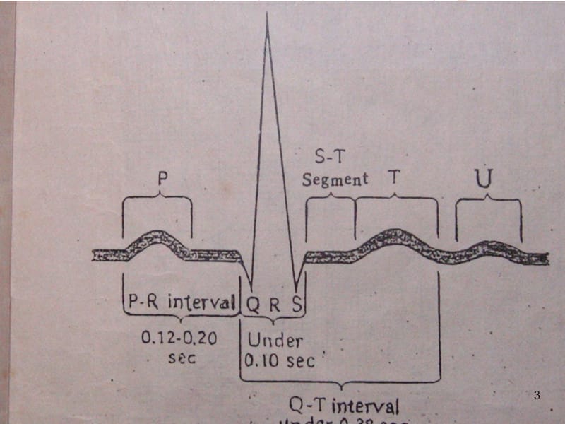 常见心电图诊断ppt课件_第3页