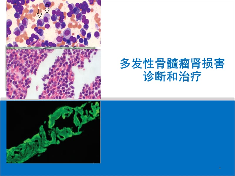 多发骨髓瘤肾损害ppt课件_第1页