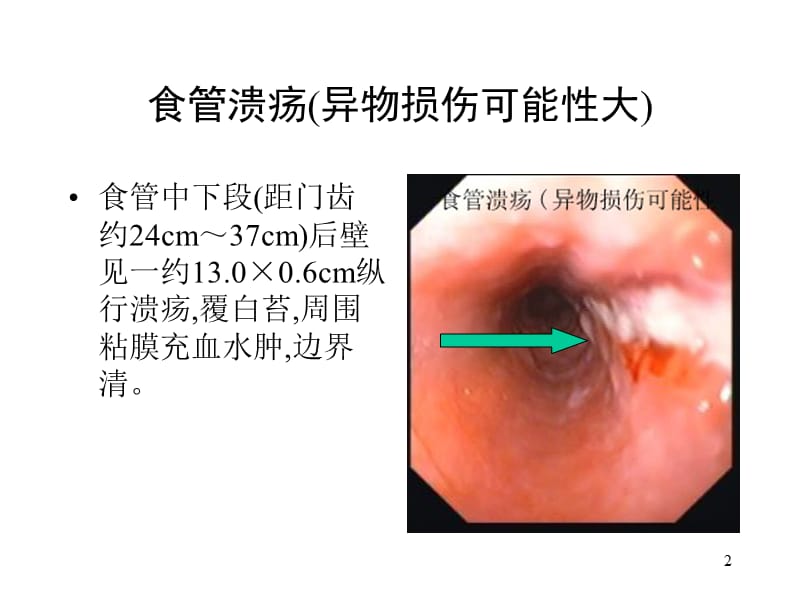 典型内镜图片ppt课件_第2页