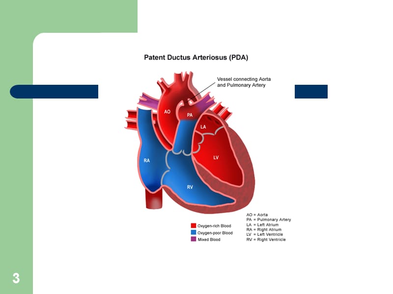 动脉导管未闭ppt课件_第3页
