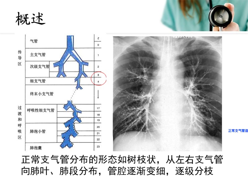 儿童支气管扩张ppt课件_第3页