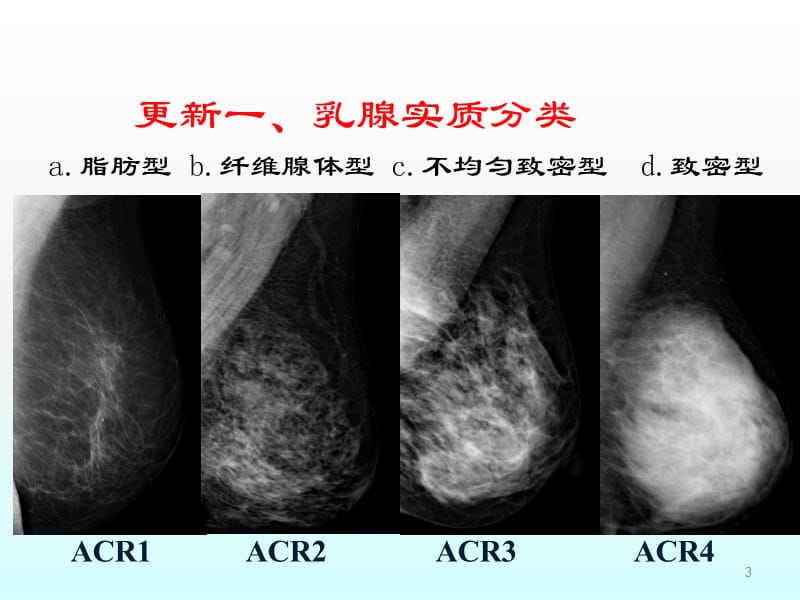 第五版BI-RADS分类更新解读乳腺钼靶ppt课件_第3页