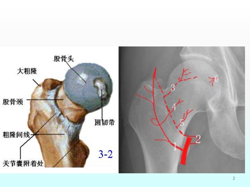 儿童股骨头坏死的诊断和治疗ppt课件_第2页