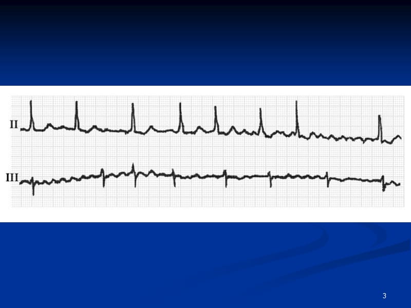 房颤的心电图诊断ppt课件_第3页