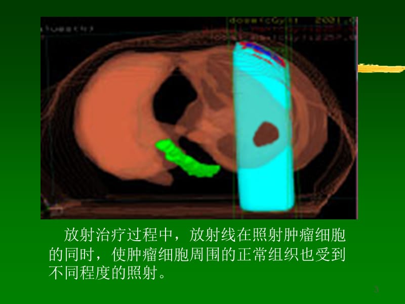 放射治疗技术进展ppt课件_第3页