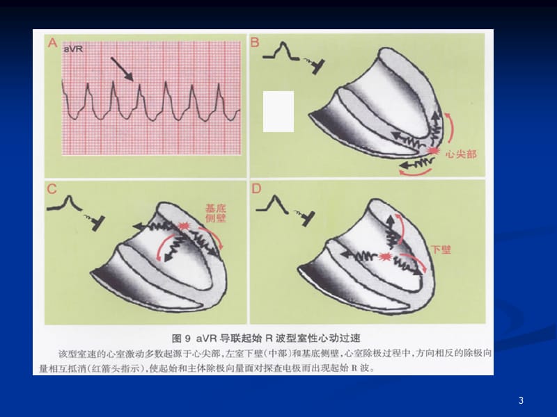 aVR单导联新流程4步诊断ppt课件_第3页