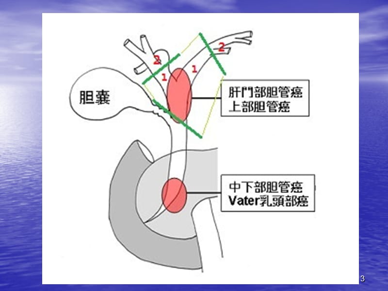 肝门部胆管癌ppt课件_第3页