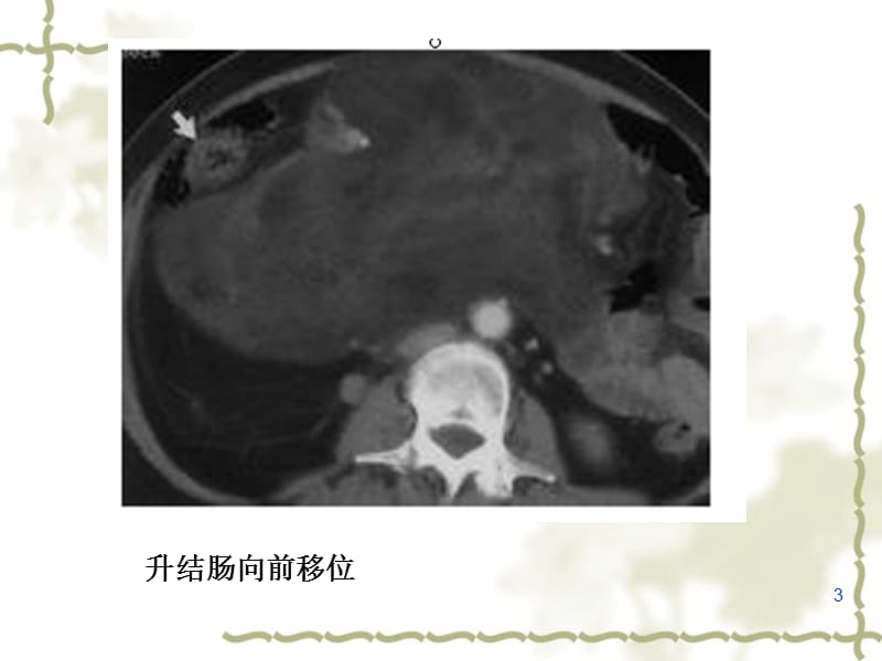 腹膜后神经源性肿瘤ppt课件_第3页