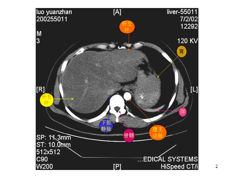 腹部CT腹部疾病正常对照并配有注释ppt课件_第2页
