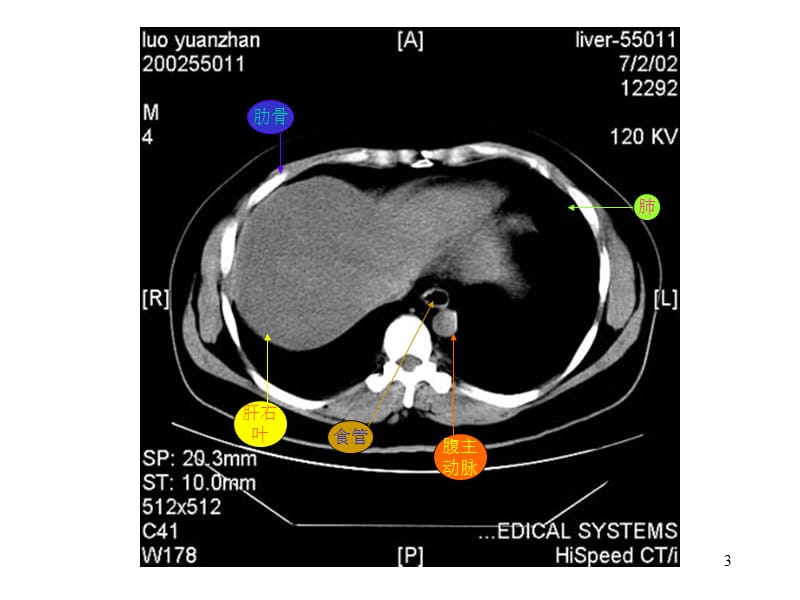 腹部CT腹部疾病正常对照并配有注释ppt课件_第3页