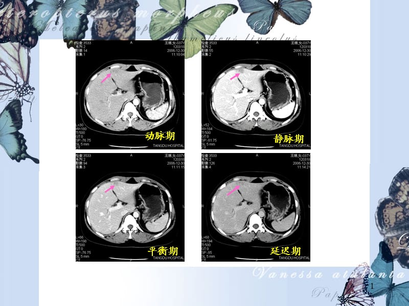 肝脏镰状韧带旁假ppt课件_第1页