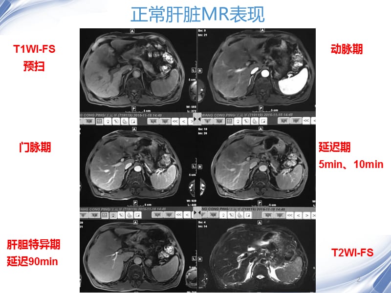 肝脏的MR表现ppt课件_第2页